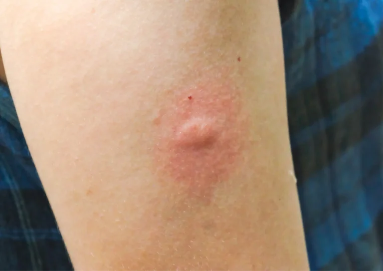 bouton de moustique tigre, allergie, extermination urgente