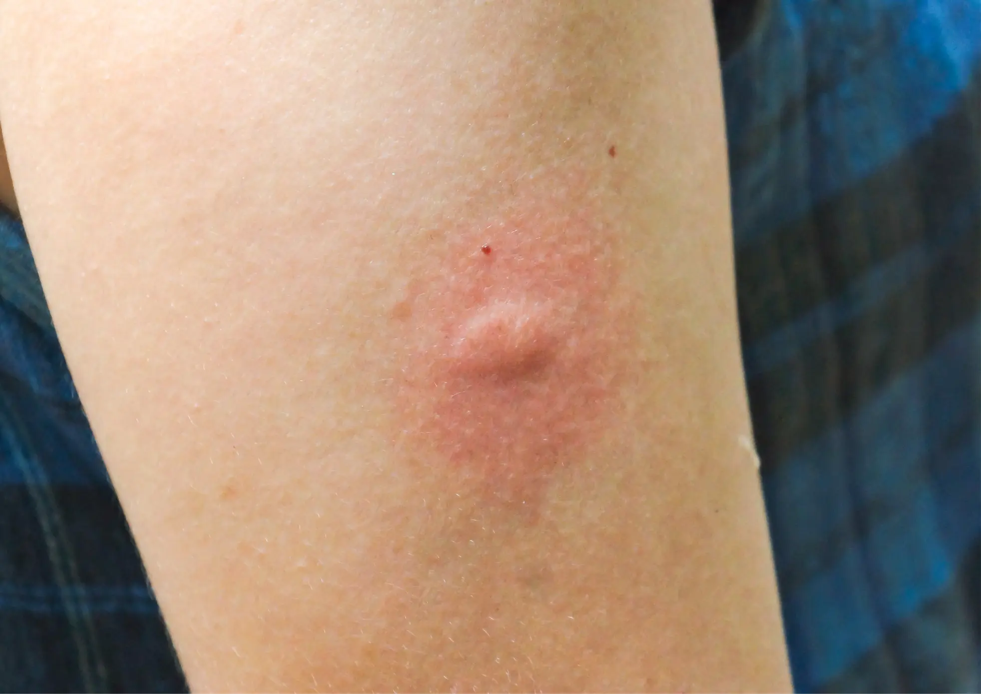 Bouton de piqûre de moustique tigre sur la peau, avec rougeur localisée et irritation visible