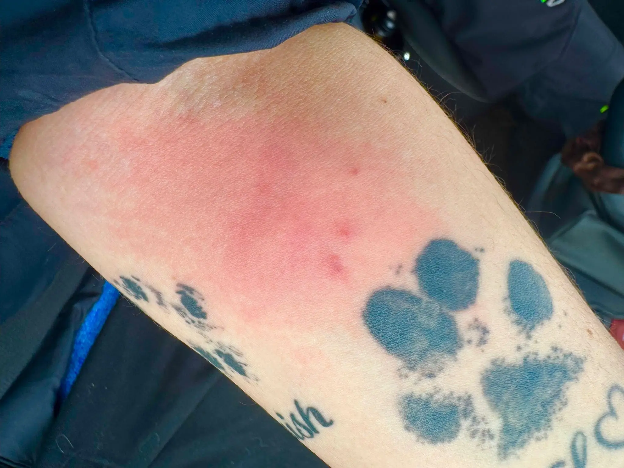 réaction piqûre punaises de lit