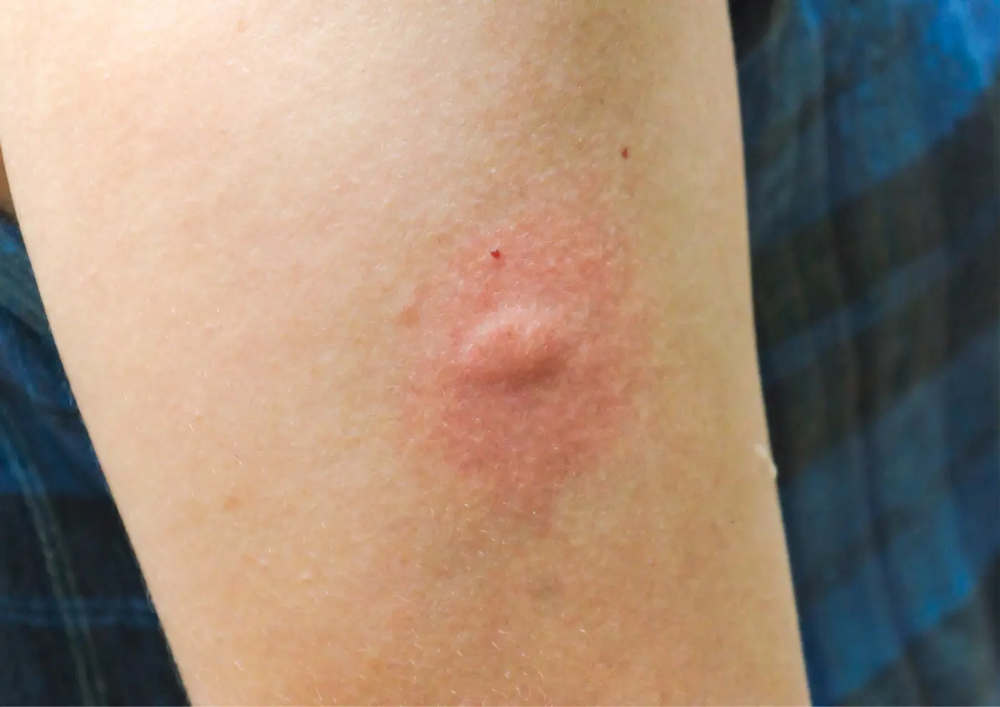 Bouton rouge provoqué par une piqûre de moustique