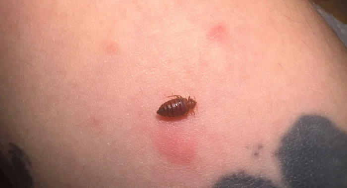 punaise de lit sur un bras qui pique, photo de Inratable